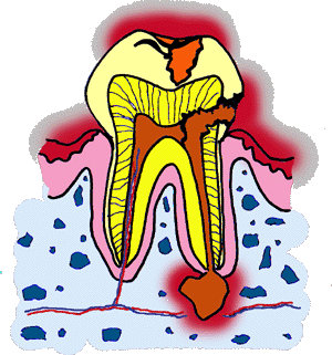 根尖性歯周組織炎