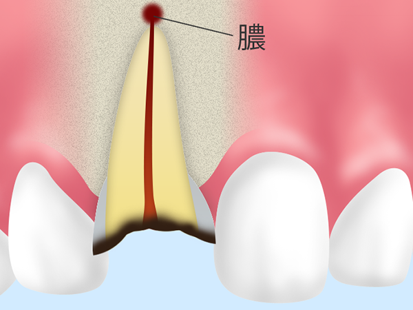 歯根 膜 炎 と は