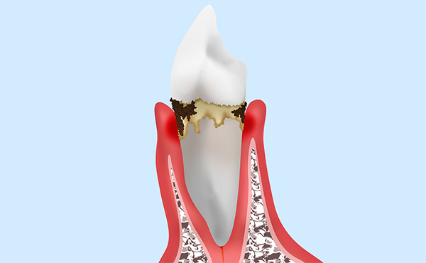 歯肉炎について教えてください。