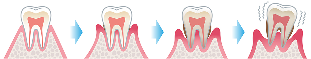 歯周病（歯槽膿漏〕はどうしてこわいのですか。