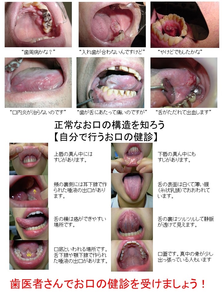 口腔がん（舌の病気）-初期～末期