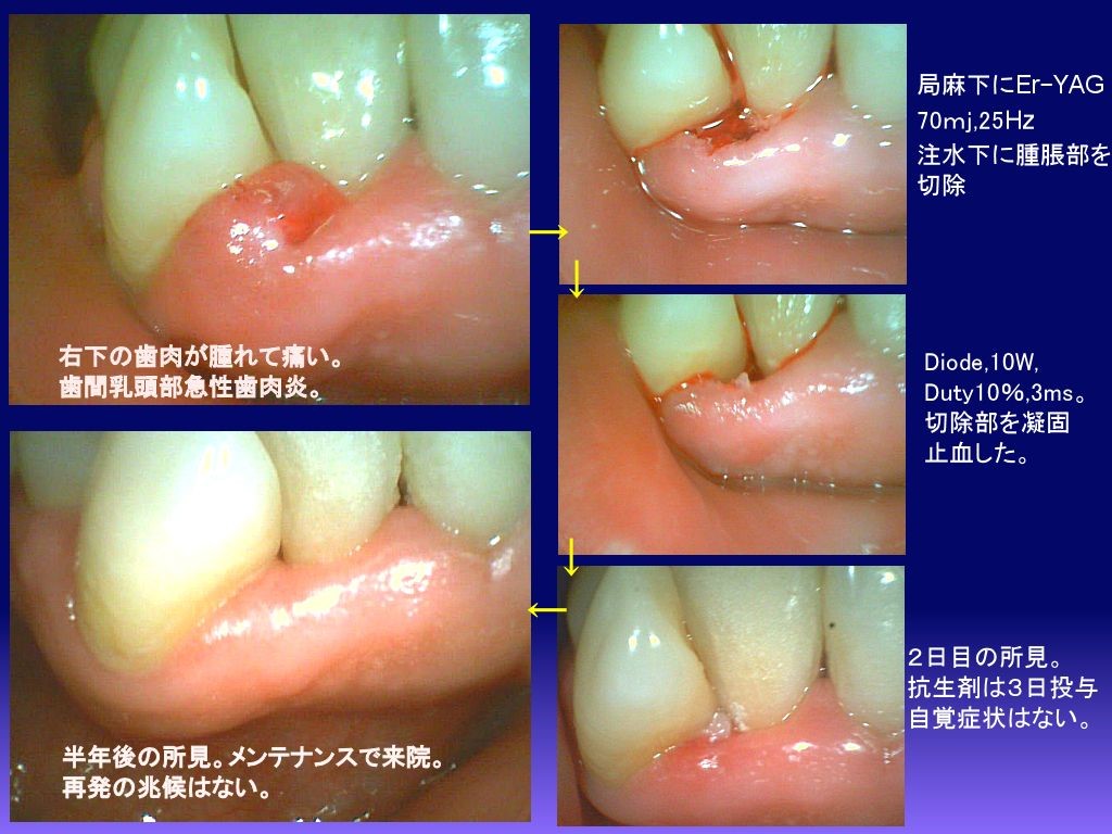 歯茎 腫れ 抗生 物質