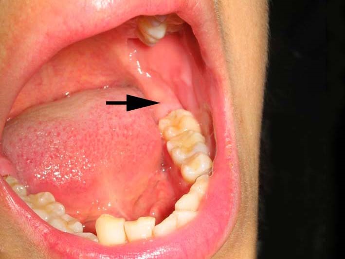 が 痛い 歯茎 腫れ て 歯茎が腫れる5つの原因とは―症状や対処法についても詳しく解説｜吉松歯科医院公式ブログ