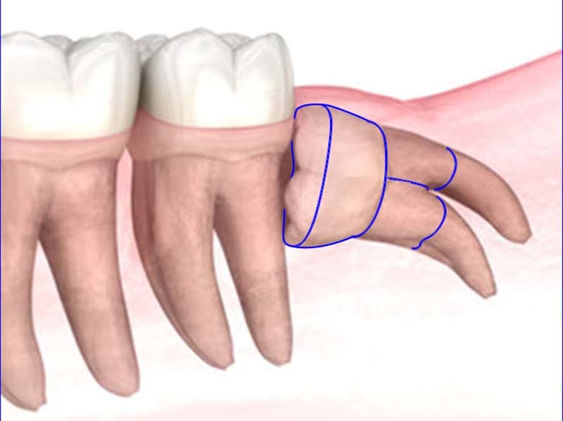 智歯の分割摘出（親知らずの抜歯）