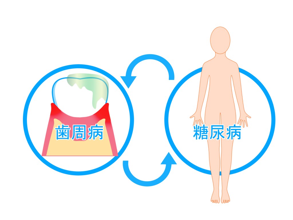 お口と全身の関係　歯周病は糖尿病の第６の合併症！