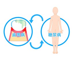 お口と全身の関係　歯周病は糖尿病の第６の合併症！