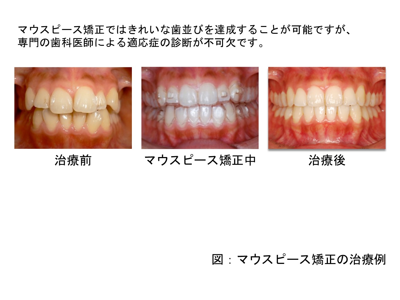 ②相歯良い歯のコンクール2