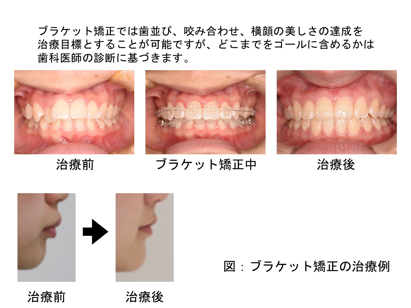 ②相歯良い歯のコンクール2