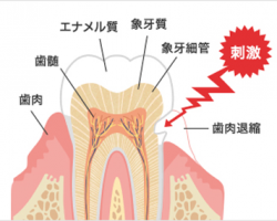 知覚過敏への歯科医師の対応