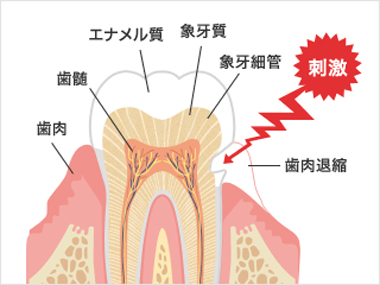 知覚過敏への歯科医師の対応