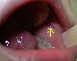 頬の裏側には耳下腺で作られた唾液の出口があります。