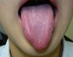 舌の表面は白くて薄い膜（糸状乳頭）でおおわれています。
