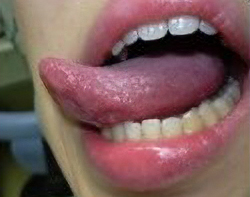 舌の横は癌ができやすい場所です。