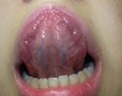舌の裏はツルツルして静脈が見えます。