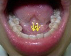 口底といわれる場所です。舌下腺や顎下腺で作られた唾液の出口があります。