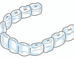 マウスピース型矯正装置のメリットとデメリットについて
